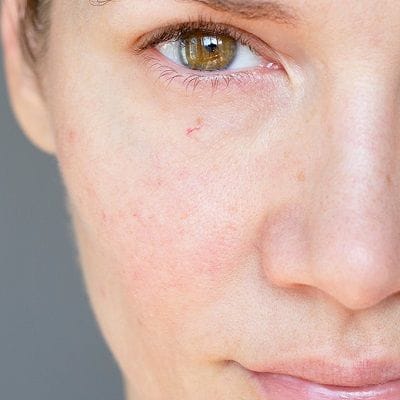 How To Get Rid of Rosacea Permanently?