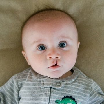 Cleft Lip Surgery in Dubai