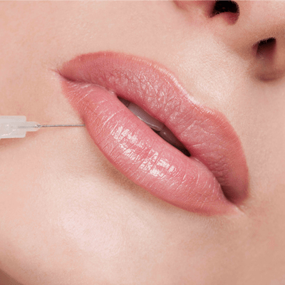 How Long Does a Lip Filler Last?