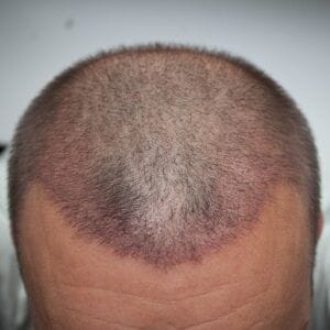 What Does 2000 Hair Grafts Look Like?