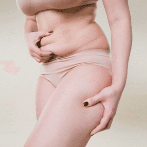 Does Liposuction Tighten Loose Skin?