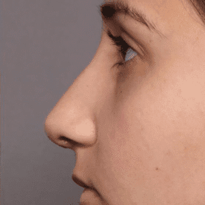 Does Nose Reshaping Make You Look Younger?