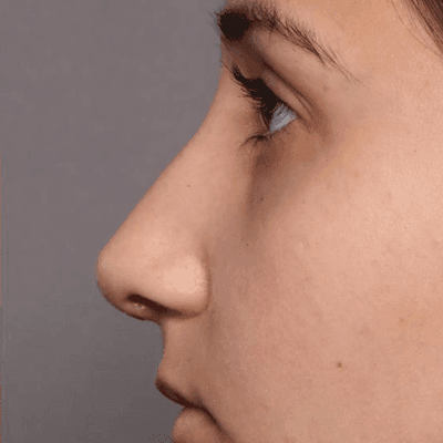 Does Nose Reshaping Make You Look Younger?