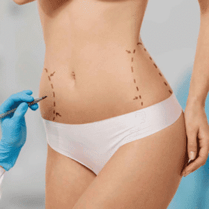 How Long Do Tummy Tuck Results Last?
