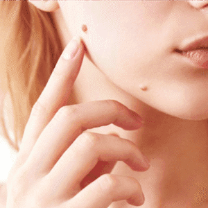 How to Permanently Get Rid of Warts?