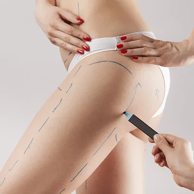 Vaser 4D liposuction in Dubai I VASER Lipo Dubai