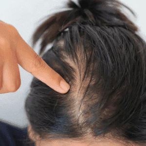 What is the Best Hair Loss Treatment?