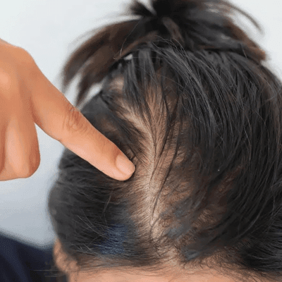 What is the Best Hair Loss Treatment?