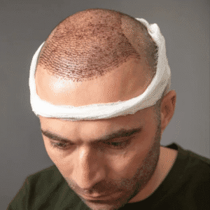 How Long Does a FUT Hair Transplant Last?
