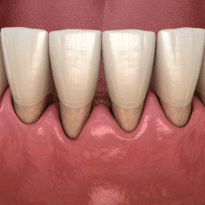 Can You Repair Receding Gums?