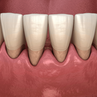 Can You Repair Receding Gums?