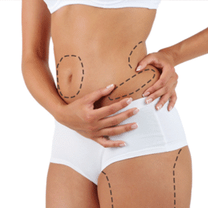 How Long Do Liposuction Results Last?