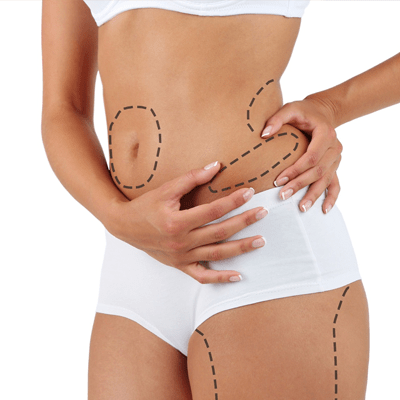 How Long Do Liposuction Results Last?