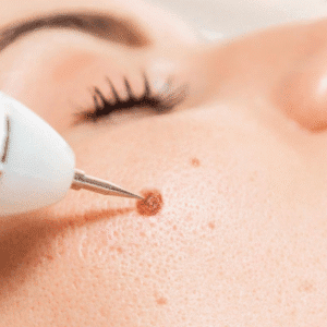 How to Remove Moles From Face Permanently?