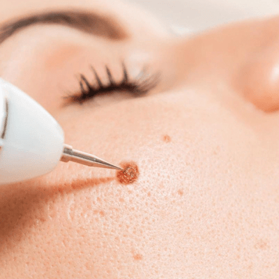 How to Remove Moles From Face Permanently?