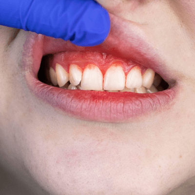 What Do I Do if My Gums Are Bleeding?