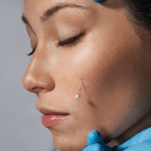 What is the Best Age for a Thread Lift?