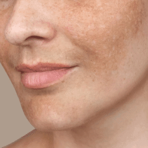 How to Quickly Fade Hyperpigmentation?