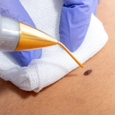 4 Dermatologist Recommended Ways To Get Rid Of Warts 1 4 Dermatologist Recommended Ways To Get Rid Of Warts