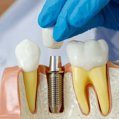 4 Types of Dental Implants 1 4 Types of Dental Implants