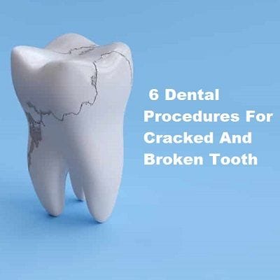 6 Dental Procedures for Cracked and Broken Tooth