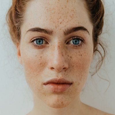 8 Treatment Options for Hyperpigmentation