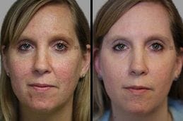 Acne Scar Treatment Dubai Silicon Oasis Before & After