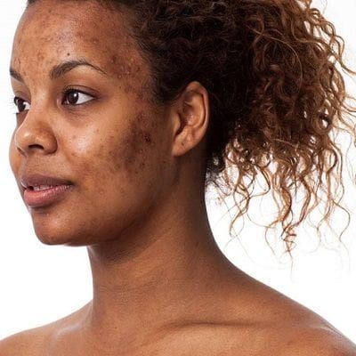 Acne Scar Treatment for Brown Skin 1 Acne Scar Treatment for Brown Skin