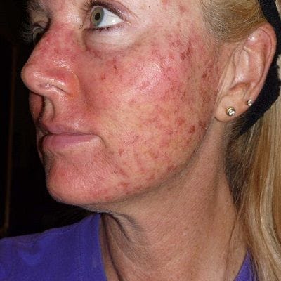 Actinic Keratosis Cost