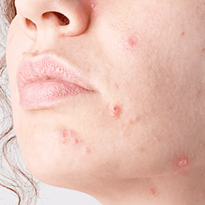 Actinic Keratosis: Current Treatment Options