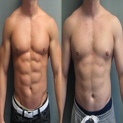 Advantages and Disadvantages of Gynecomastia Surgery