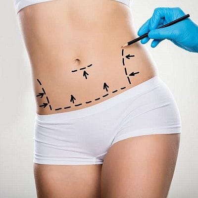 Affordable Tummy Tuck Surgery
