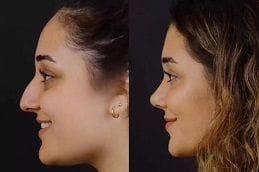 Alarplasty in Dubai 5 Alarplasty in Dubai Before and After
