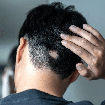 Alopecia Areata: Can Patchy Hair Loss Be Treated? 1 Alopecia Areata Can Patchy Hair Loss Be Treated