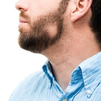 Alopecia Areata Treatment, Causes, and Symptoms. 1 Alopecia Areata Hair Loss