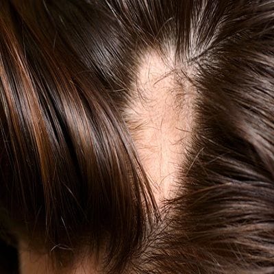 Alopecia areata in dubai