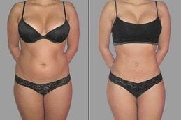 Adipose Lipolysis Injections 6 Before & After Adipose Lipolysis Injections