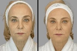 Biorevitalization 6 Before & After Biorevitalization Treatment in Dubai