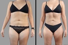 Before & After Body Contouring Silicon Oasis