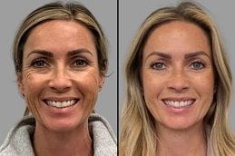 Botox Injection Dubai 4 Before & After Botox in Dubai
