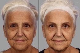 Botox Injection Dubai 6 Before & After Botox