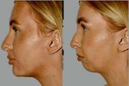 Cheek Augmentation 4 Before & After Cheek Augmentation