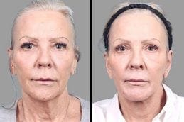 Before & After Chemical Peels Silicon Oasis