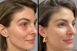 Chemical Peel In Dubai 4 Before & After Chemical Peels in Dubai
