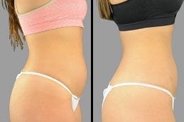 Before & After Fat Reduction Silicon Oasis