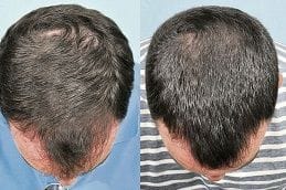 Hair Loss Treatment 4 Before & After Hair Loss Treatment in Dubai