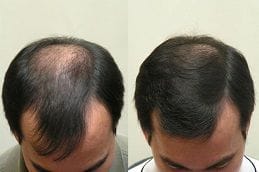 Hair Loss Treatment 6 Before & After Hair Loss Treatment