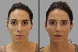 Before & After Hyaluronic Acid Injections in Dubai
