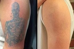 Before & After Laser Tattoo Removal Dubai Silicon Oasis