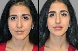 Lip Fillers Injections 4 Before & After Lip Fillers Injections